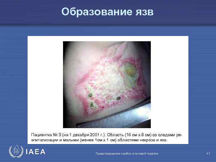 Образование язв Пациентка № 3 (на 1 декабря 2001 г. ). Область (16 см