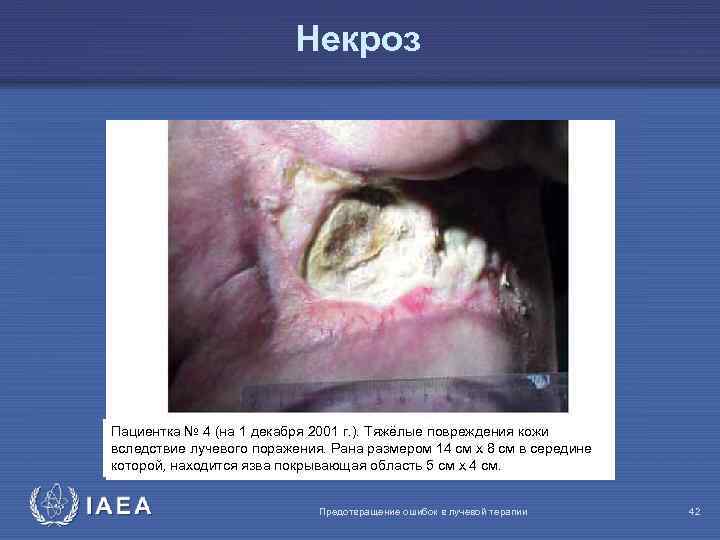 Некроз Пациентка № 4 (на 1 декабря 2001 г. ). Тяжёлые повреждения кожи вследствие