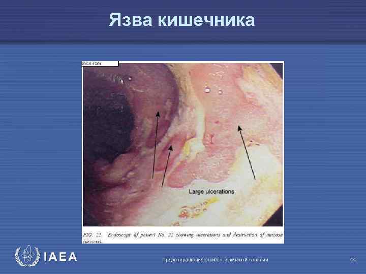 Язва кишечника IAEA Предотвращение ошибок в лучевой терапии 44 
