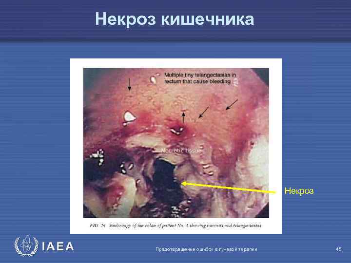 Некроз кишечника Некроз IAEA Предотвращение ошибок в лучевой терапии 45 