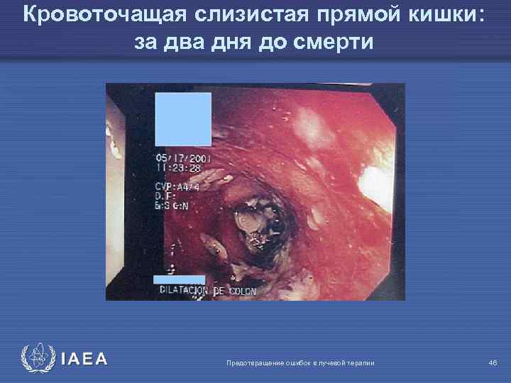 Кровоточащая слизистая прямой кишки: за два дня до смерти IAEA Предотвращение ошибок в лучевой