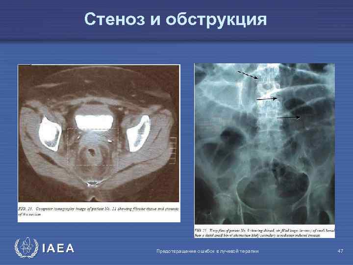 Стеноз и обструкция IAEA Предотвращение ошибок в лучевой терапии 47 