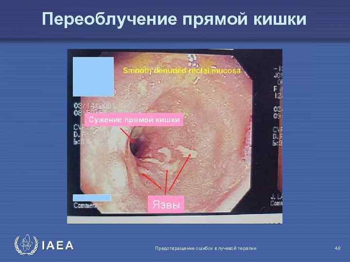 Переоблучение прямой кишки Сужение прямой кишки Язвы IAEA Предотвращение ошибок в лучевой терапии 48
