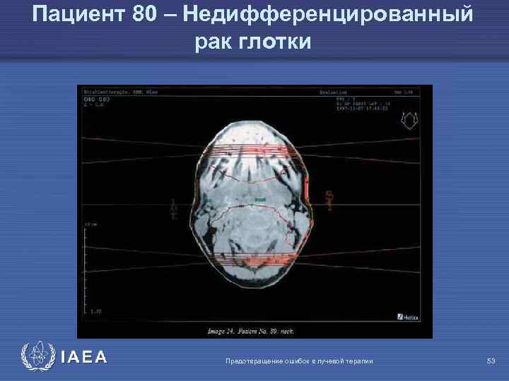 Пациент 80 – Недифференцированный рак глотки IAEA Предотвращение ошибок в лучевой терапии 53 