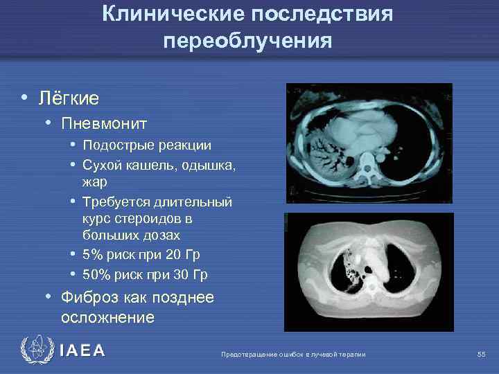 Клинические последствия переоблучения • Лёгкие • Пневмонит • Подострые реакции • Сухой кашель, одышка,