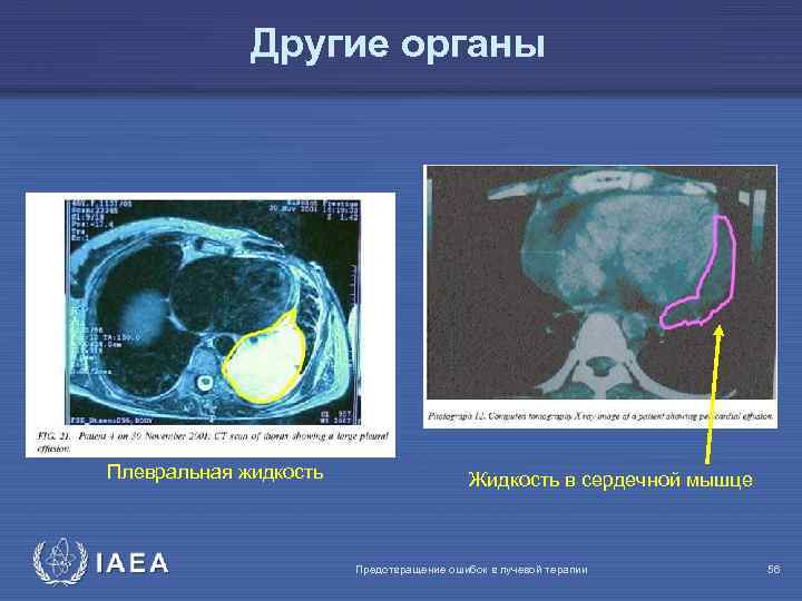 Другие органы Плевральная жидкость IAEA Жидкость в сердечной мышце Предотвращение ошибок в лучевой терапии