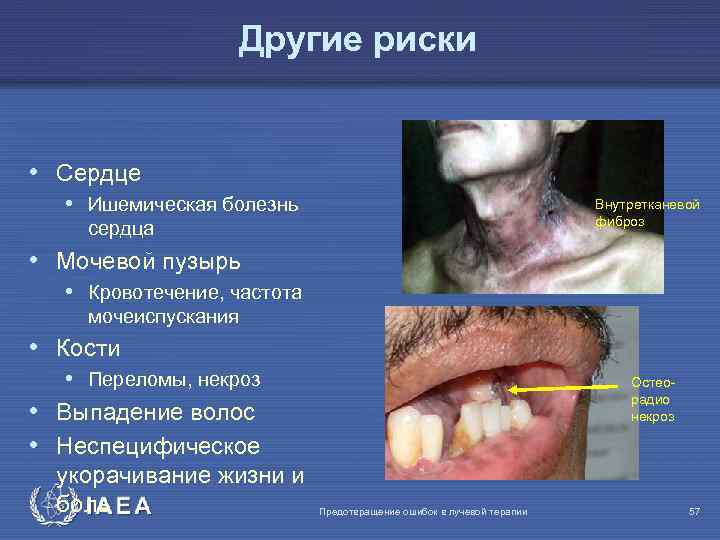 Другие риски • Сердце • Ишемическая болезнь Внутретканевой фиброз сердца • Мочевой пузырь •