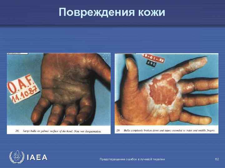 Повреждения кожи IAEA Предотвращение ошибок в лучевой терапии 62 