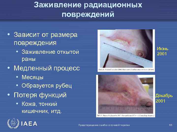Заживление радиационных повреждений • Зависит от размера повреждения • Заживление откытой раны Июнь 2001