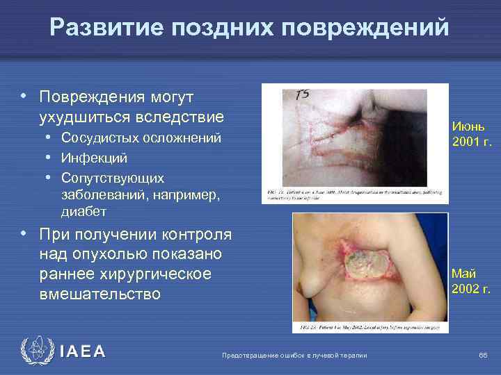 Развитие поздних повреждений • Повреждения могут ухудшиться вследствие • Сосудистых осложнений • Инфекций •