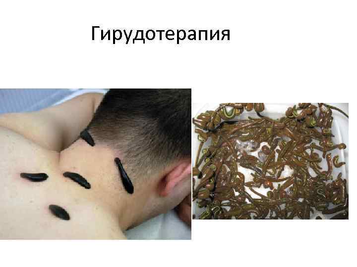 Гирудотерапия 