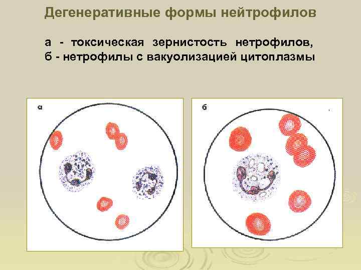 Дегенеративные формы нейтрофилов а - токсическая зернистость нетрофилов, б - нетрофилы с вакуолизацией цитоплазмы