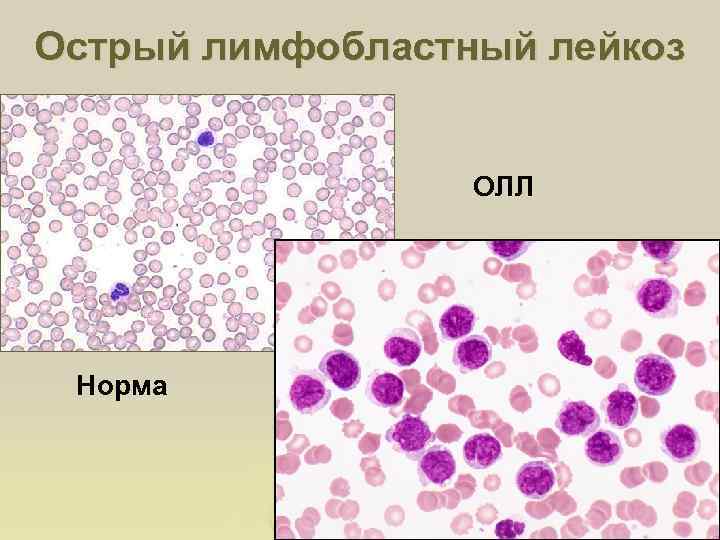 Острый лимфобластный лейкоз ОЛЛ Норма 