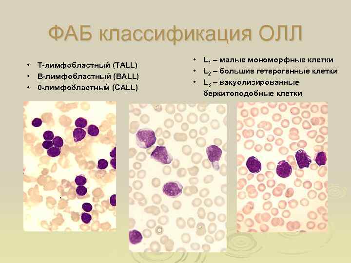 ФАБ классификация ОЛЛ • Т-лимфобластный (TALL) • В-лимфобластный (ВALL) • 0 -лимфобластный (CALL) •