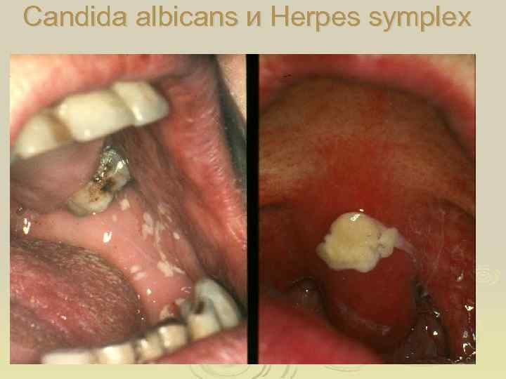 Candida albicans и Herpes symplex 