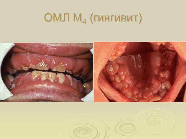 ОМЛ М 4 (гингивит) 