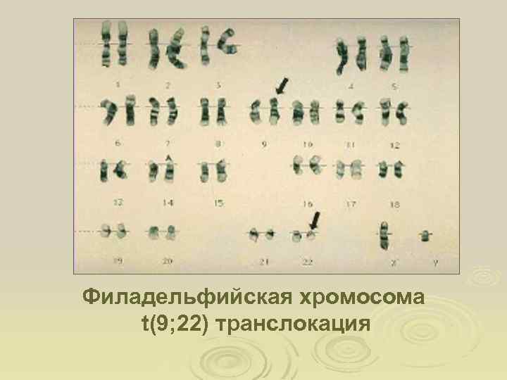 Филадельфийская хромосома t(9; 22) транслокация 