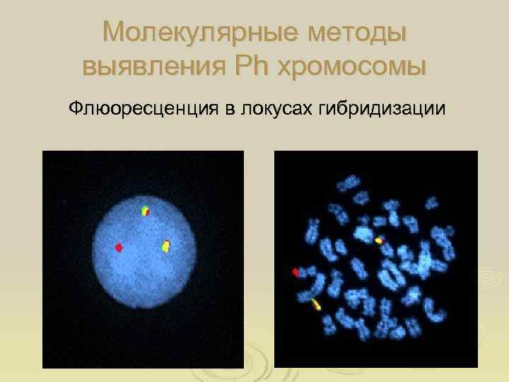 Молекулярные методы выявления Ph хромосомы Флюоресценция в локусах гибридизации Интерфаза Метафаза 