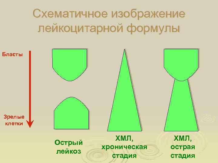 Схематичное изображение лейкоцитарной формулы Бласты Зрелые клетки Острый лейкоз ХМЛ, хроническая стадия ХМЛ, острая