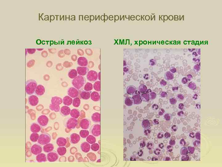 Хр миелолейкоз картина крови