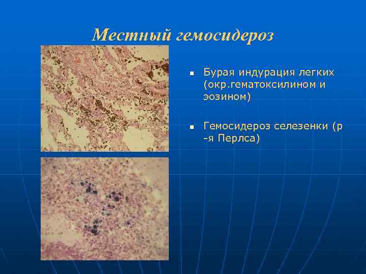 Местный гемосидероз n n Бурая индурация легких (окр. гематоксилином и эозином) Гемосидероз селезенки (р