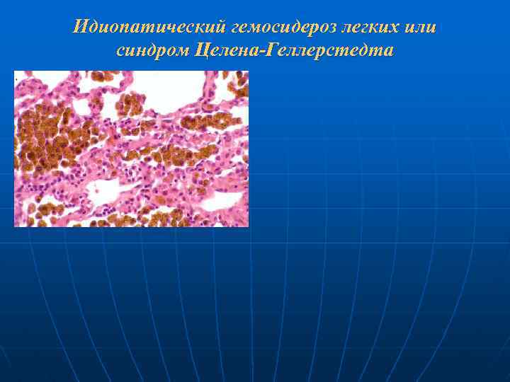 Идиопатический гемосидероз легких или синдром Целена-Геллерстедта 