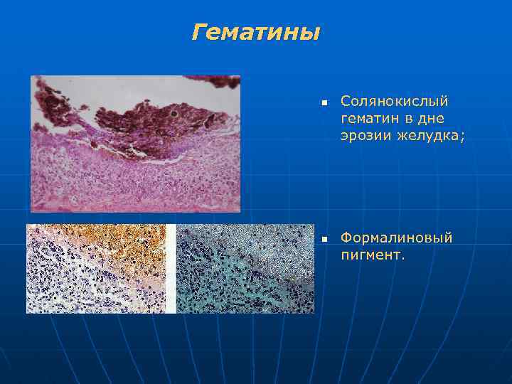 Гематины n n Солянокислый гематин в дне эрозии желудка; Формалиновый пигмент. 