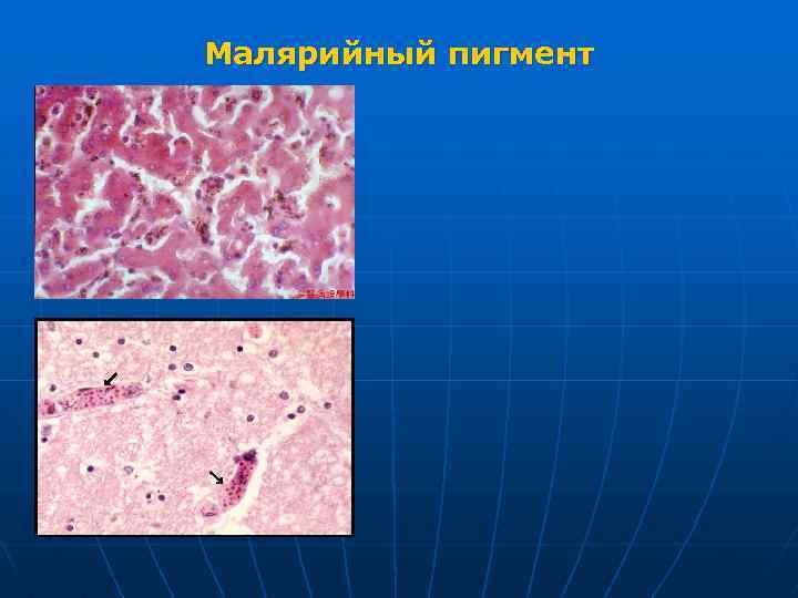 Малярийный пигмент 