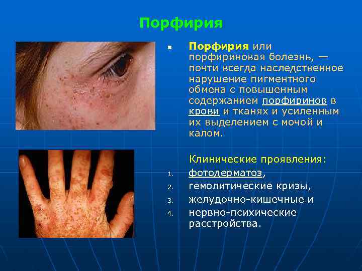Порфирия n 1. 2. 3. 4. Порфирия или порфириновая болезнь, — почти всегда наследственное