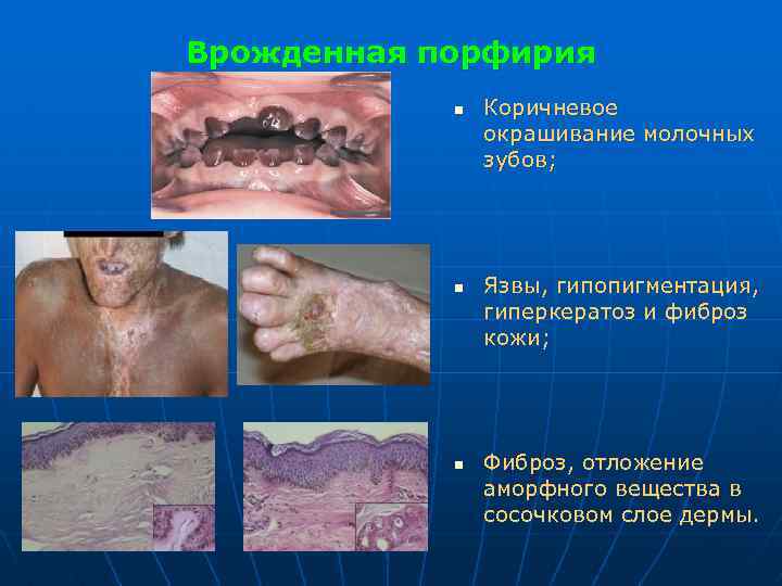 Врожденная порфирия n n n Коричневое окрашивание молочных зубов; Язвы, гипопигментация, гиперкератоз и фиброз