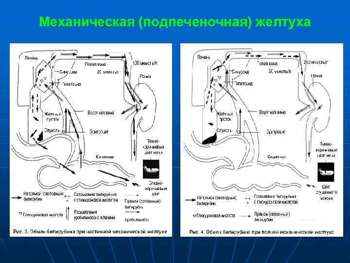 Механическая (подпеченочная) желтуха 