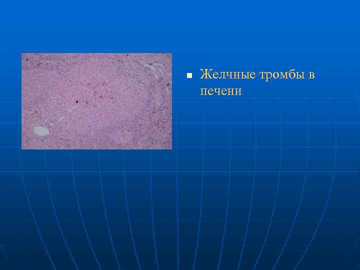 n Желчные тромбы в печени 