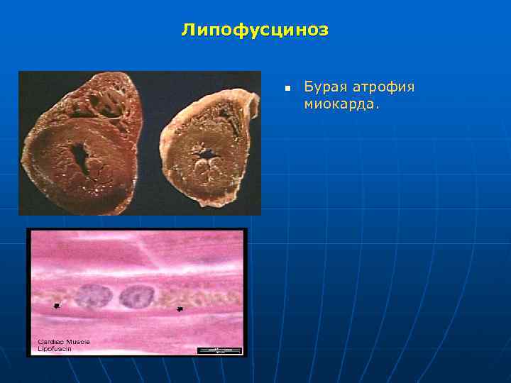Липофусциноз n Бурая атрофия миокарда. 