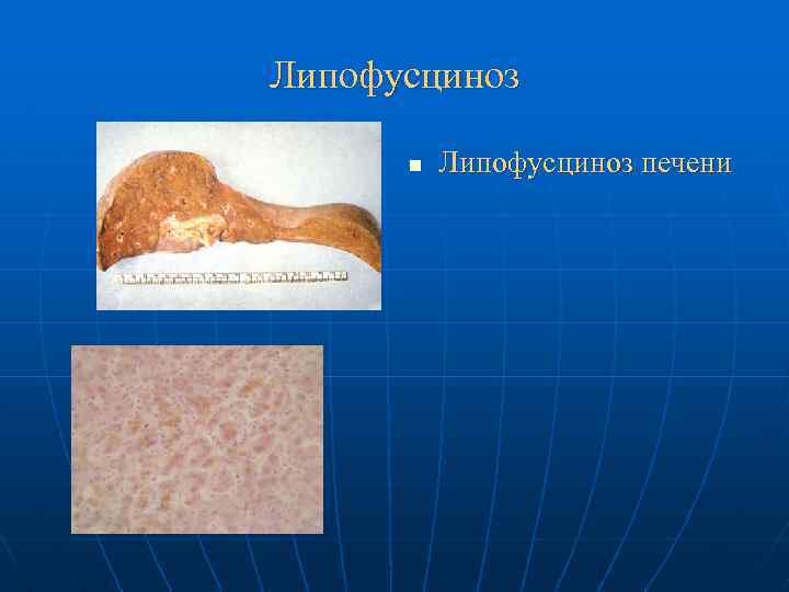 Липофусциноз n Липофусциноз печени 