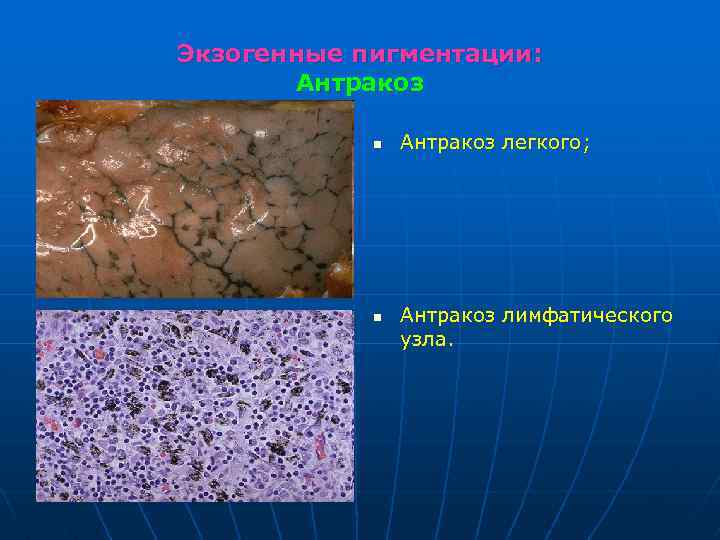 Экзогенные пигментации: Антракоз n n Антракоз легкого; Антракоз лимфатического узла. 
