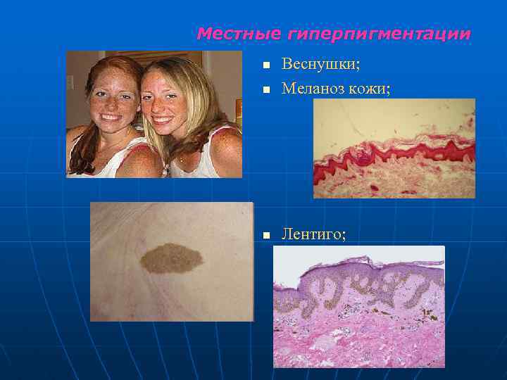 Местные гиперпигментации n Веснушки; Меланоз кожи; n Лентиго; n 