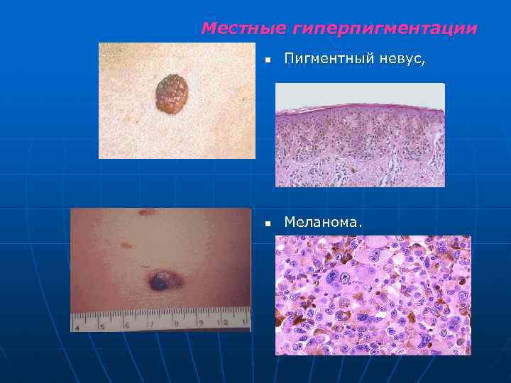 Местные гиперпигментации n Пигментный невус, n Меланома. 