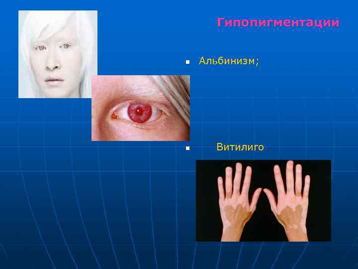 Гипопигментации n n Альбинизм; Витилиго 