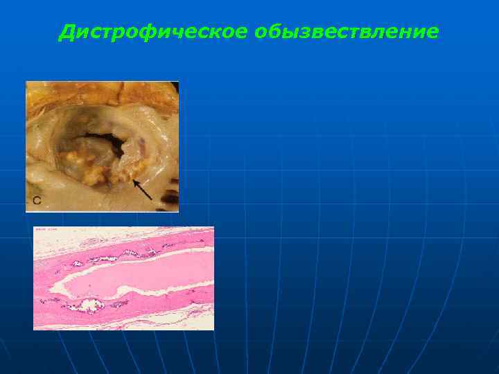 Дистрофическое обызвествление 