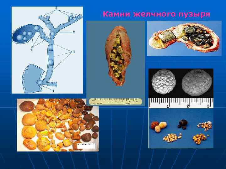 Камни желчного пузыря 