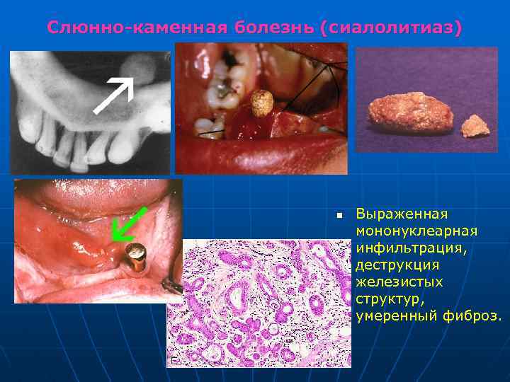Слюнно-каменная болезнь (сиалолитиаз) n Выраженная мононуклеарная инфильтрация, деструкция железистых структур, умеренный фиброз. 