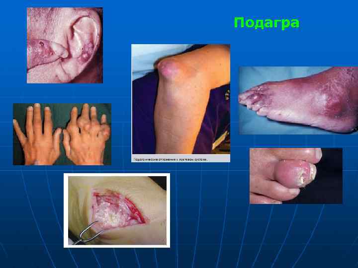 Подагра 
