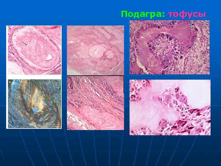 Подагра: тофусы 
