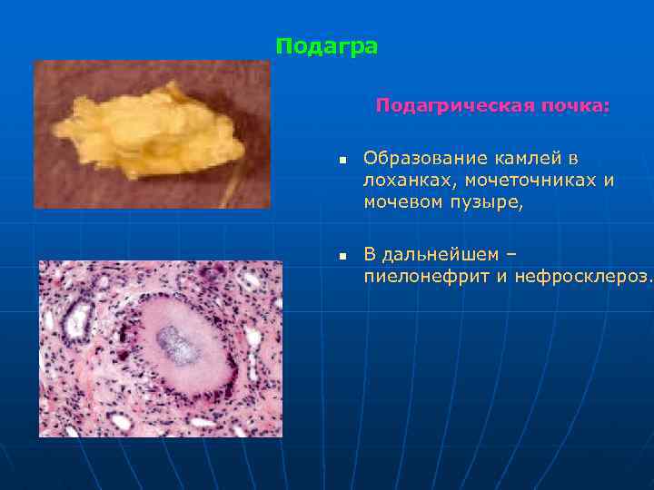 Подагра Подагрическая почка: n n Образование камлей в лоханках, мочеточниках и мочевом пузыре, В