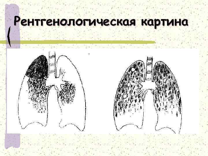 Для рентгенологической картины туберкулеза почки характерна