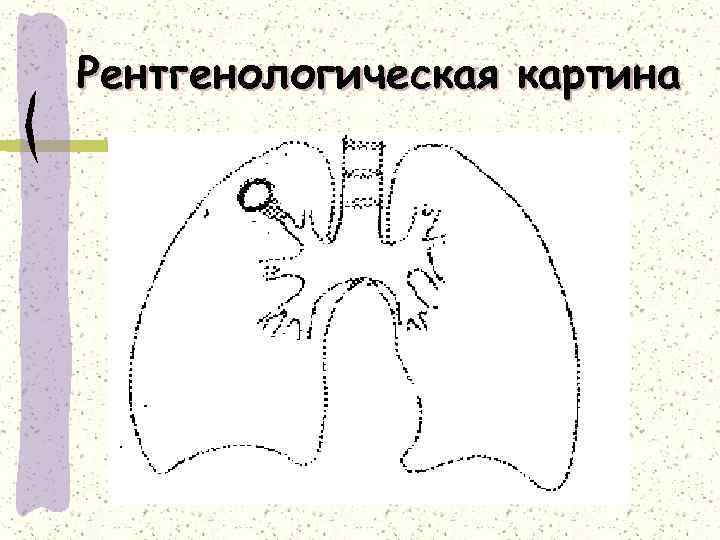 Рентгенологическая картина 