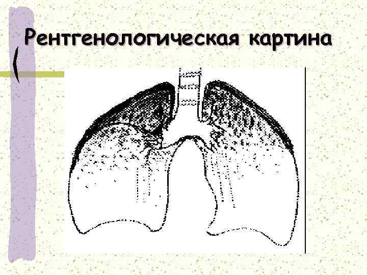 Рентгенологическая картина