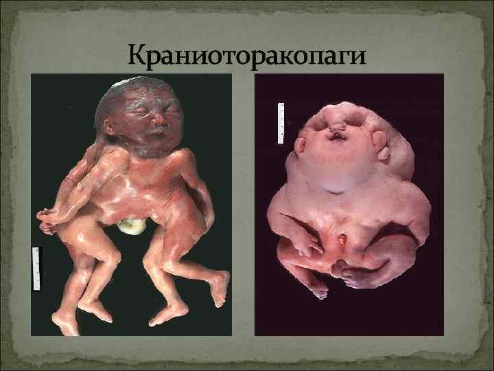 Краниоторакопаги 