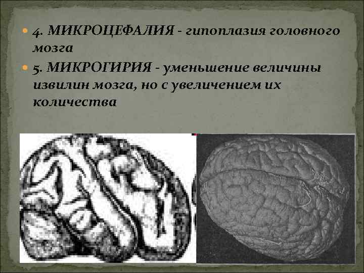Гипоплазия правой головного мозга. Микрогирия головного мозга. Микроцефалия головного мозга. Гипоплазия головного мозга. Микрогирия и макрогирия.