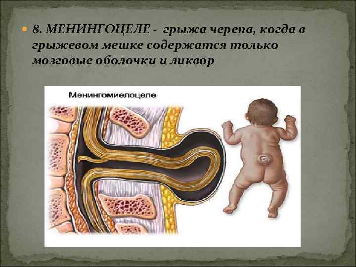  8. МЕНИНГОЦЕЛЕ - грыжа черепа, когда в грыжевом мешке содержатся только мозговые оболочки